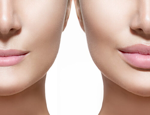 Lip Lift: Η μικροεπέμβαση που αναβαθμίζει το πρόσωπο