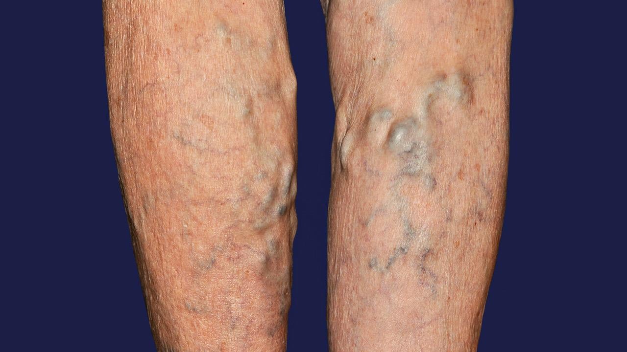 18 απαντήσεις για τους κιρσούς των κάτω άκρων